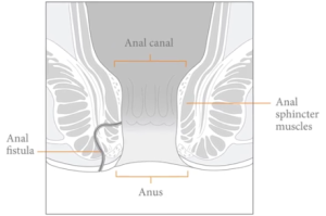 Anal Fistula Cures and Procedures