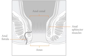 Anal Procedures Colorectal Surgey Los Angeles