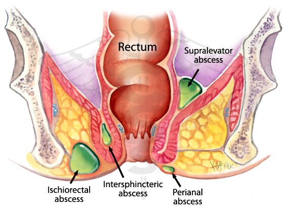 pilonidal sinus hole #11